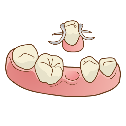 （部分）入れ歯