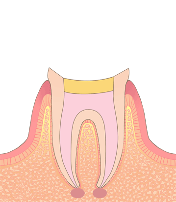 充填剤で密封